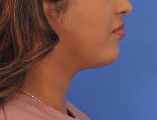 Chin Filler Before & After Gallery - Patient 297798 - Image 2