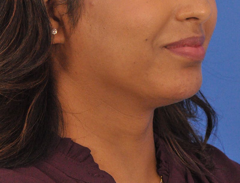 Chin Filler Before & After Gallery - Patient 297798 - Image 3