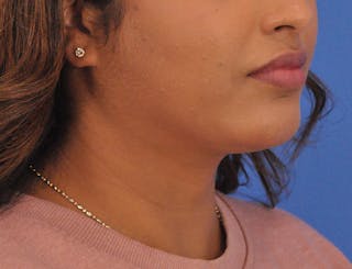 Chin Filler Before & After Gallery - Patient 297798 - Image 4