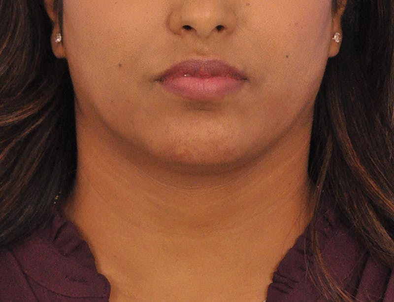 Chin Filler Before & After Gallery - Patient 297798 - Image 5