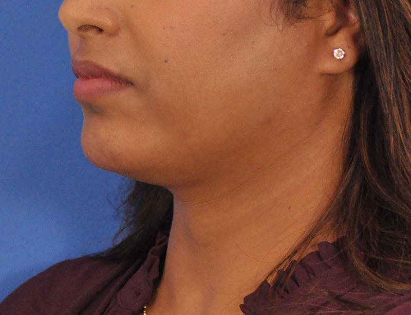 Chin Filler Before & After Gallery - Patient 297798 - Image 7
