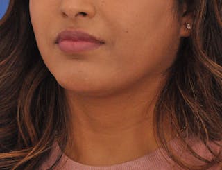 Chin Filler Before & After Gallery - Patient 297798 - Image 8