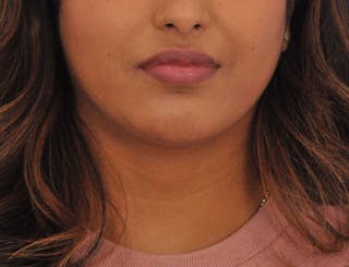 Chin Filler Before & After Gallery - Patient 297798 - Image 6