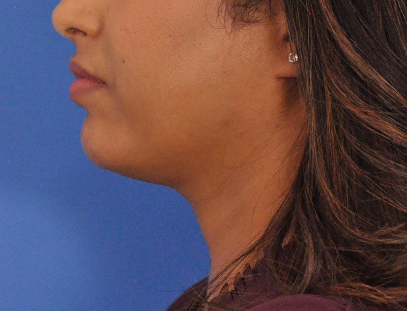 Chin Filler Before & After Gallery - Patient 297798 - Image 9