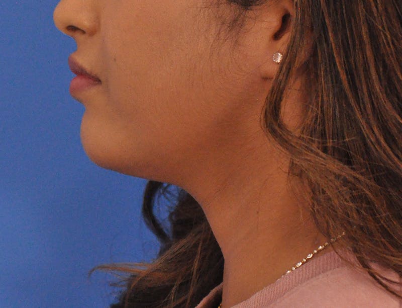 Chin Filler Before & After Gallery - Patient 297798 - Image 10