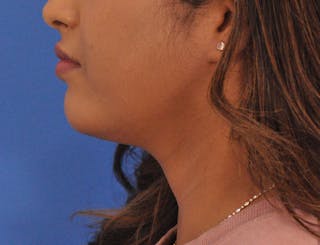 Chin Filler Before & After Gallery - Patient 297798 - Image 10