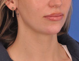 Chin Filler Before & After Gallery - Patient 144543 - Image 4