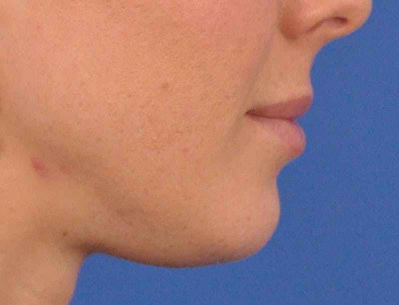 Lip Filler Before & After Gallery - Patient 144651 - Image 6