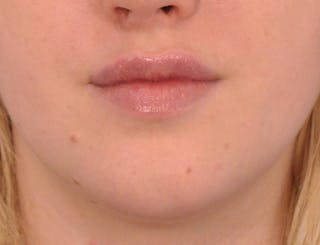 Lip Filler Before & After Gallery - Patient 377965 - Image 2