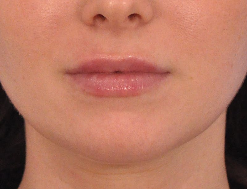 Lip Filler Before & After Gallery - Patient 788567 - Image 2