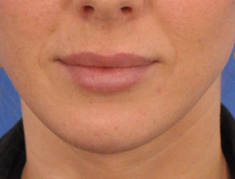 Lip Filler Before & After Gallery - Patient 144651 - Image 2