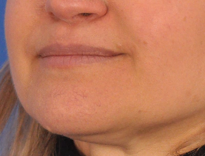 Lip Filler Before & After Gallery - Patient 844472 - Image 7