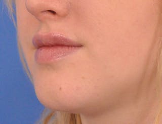 Lip Filler Before & After Gallery - Patient 377965 - Image 8