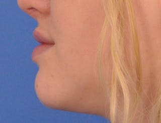 Lip Filler Before & After Gallery - Patient 377965 - Image 10