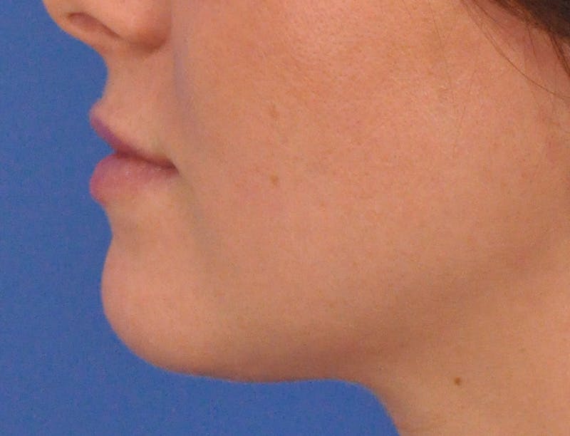 Lip Filler Before & After Gallery - Patient 788567 - Image 10