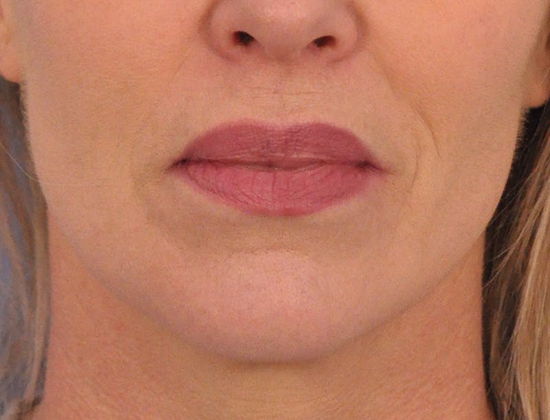 Lip Filler Before & After Gallery - Patient 399369 - Image 2