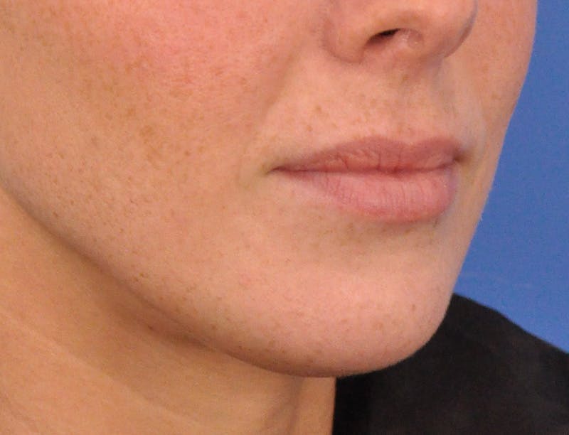Lip Filler Before & After Gallery - Patient 144651 - Image 3
