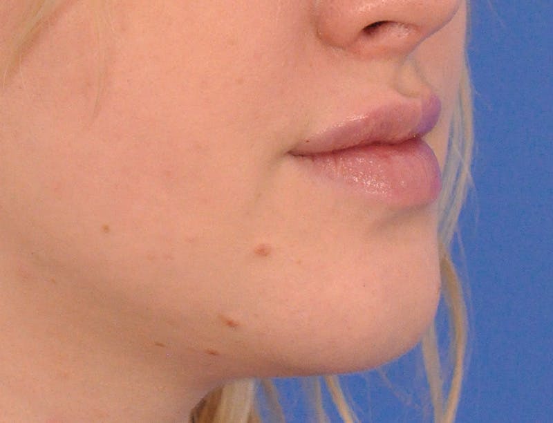 Lip Filler Before & After Gallery - Patient 377965 - Image 3
