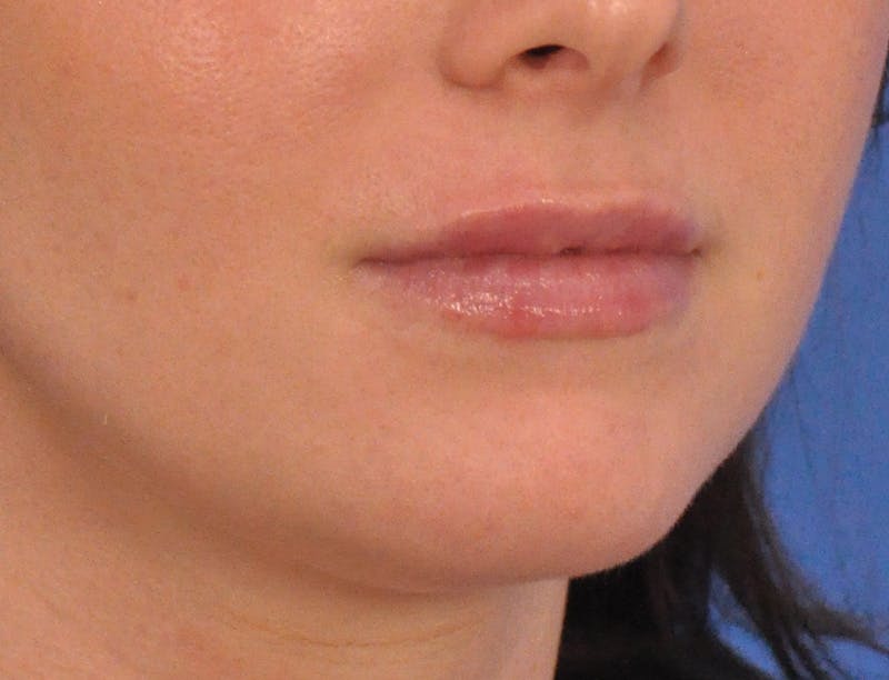 Lip Filler Before & After Gallery - Patient 788567 - Image 4