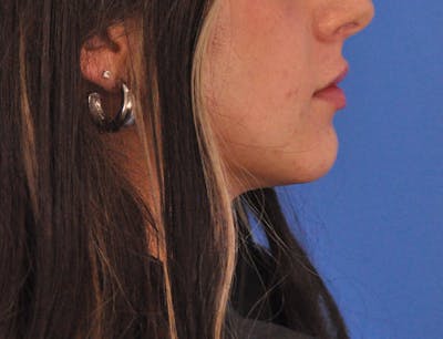Chin Filler Before & After Gallery - Patient 173428 - Image 1