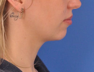 Chin Filler Before & After Gallery - Patient 144543 - Image 1