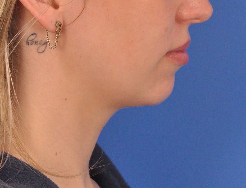 Chin Filler Before & After Gallery - Patient 144543 - Image 1
