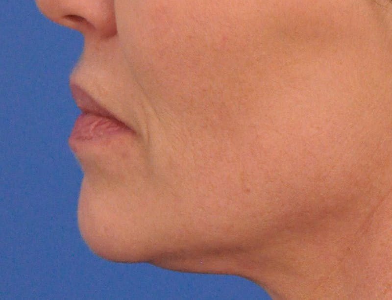 Lip Filler Before & After Gallery - Patient 399369 - Image 9