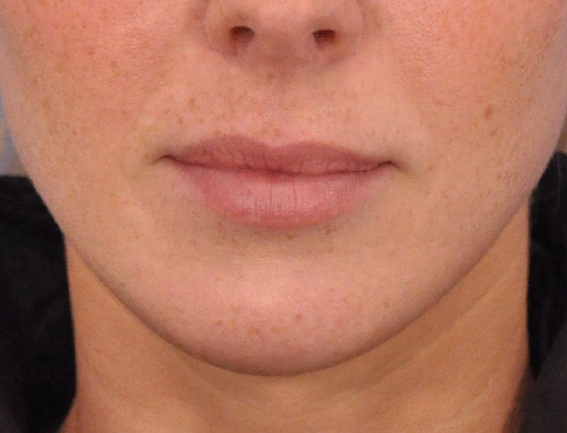 Lip Filler Before & After Gallery - Patient 144651 - Image 1