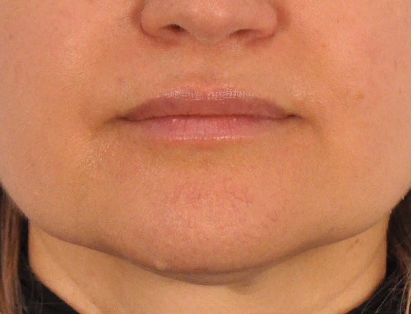 Lip Filler Before & After Gallery - Patient 844472 - Image 2