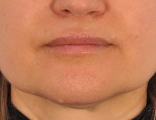 Lip Filler Before & After Gallery - Patient 844472 - Image 2