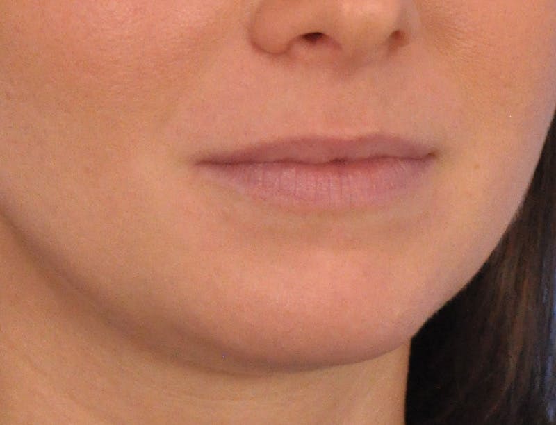 Lip Filler Before & After Gallery - Patient 788567 - Image 3