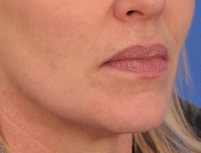 Lip Filler Before & After Gallery - Patient 399369 - Image 3