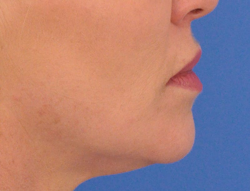 Lip Filler Before & After Gallery - Patient 399369 - Image 6