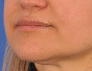 Lip Filler Before & After Gallery - Patient 844472 - Image 8