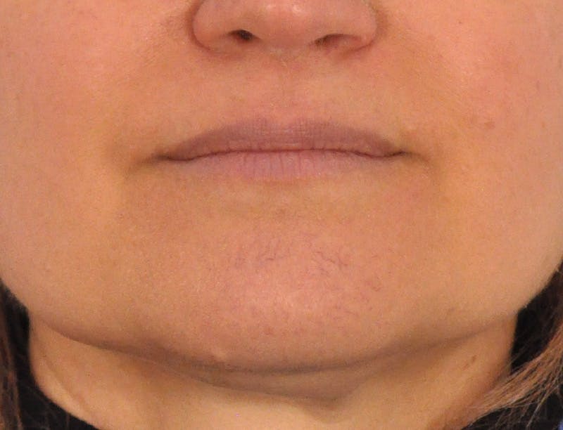 Lip Filler Before & After Gallery - Patient 844472 - Image 1