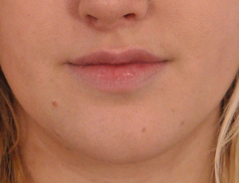 Lip Filler Before & After Gallery - Patient 377965 - Image 1