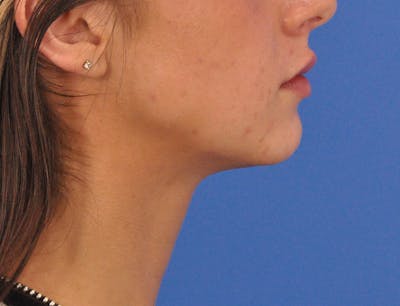 Chin Filler Before & After Gallery - Patient 173428 - Image 2