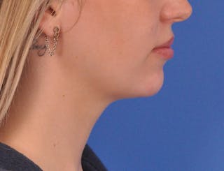 Chin Filler Before & After Gallery - Patient 144543 - Image 2