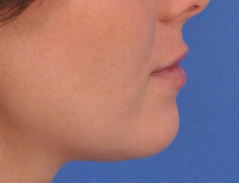 Lip Filler Before & After Gallery - Patient 788567 - Image 6