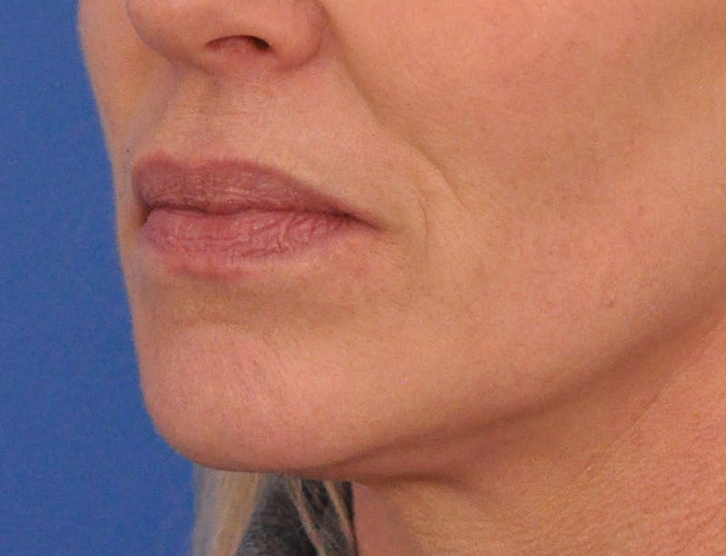 Lip Filler Before & After Gallery - Patient 399369 - Image 7