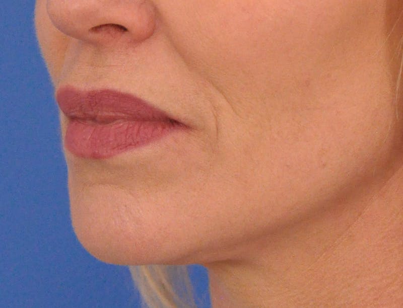 Lip Filler Before & After Gallery - Patient 399369 - Image 8
