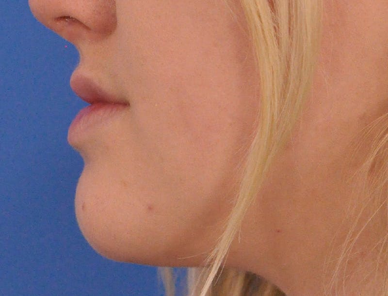 Lip Filler Before & After Gallery - Patient 377965 - Image 9