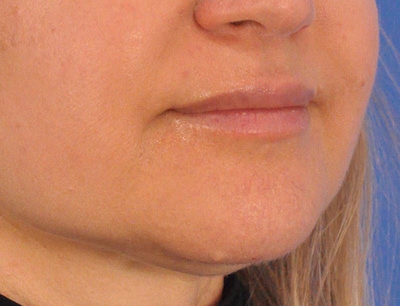 Lip Filler Before & After Gallery - Patient 844472 - Image 4