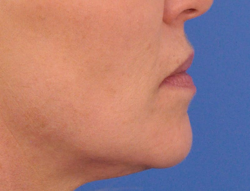 Lip Filler Before & After Gallery - Patient 399369 - Image 5