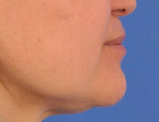 Lip Filler Before & After Gallery - Patient 844472 - Image 6