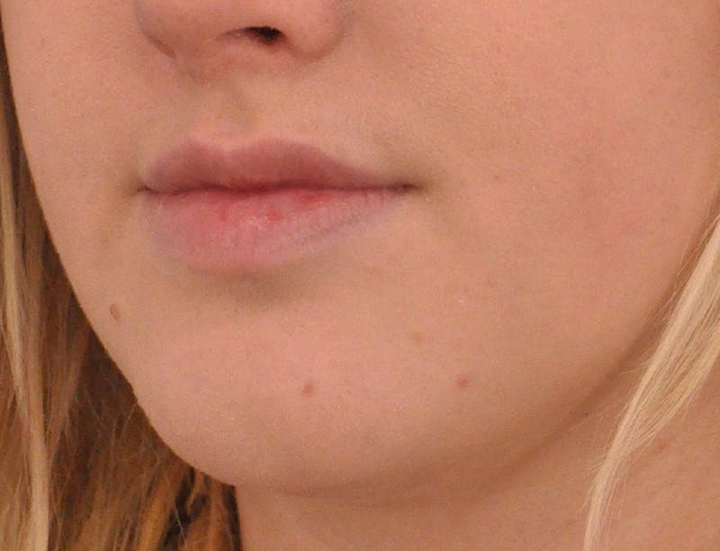 Lip Filler Before & After Gallery - Patient 377965 - Image 7