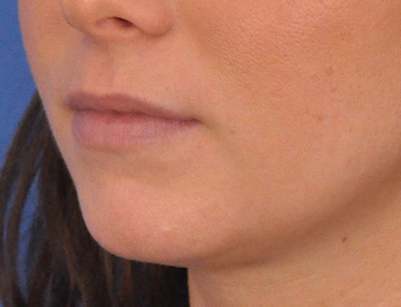 Lip Filler Before & After Gallery - Patient 788567 - Image 7