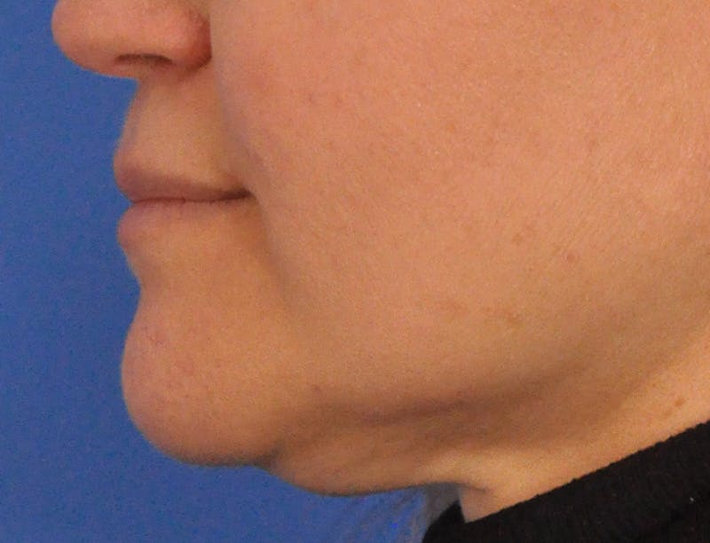 Lip Filler Before & After Gallery - Patient 844472 - Image 9