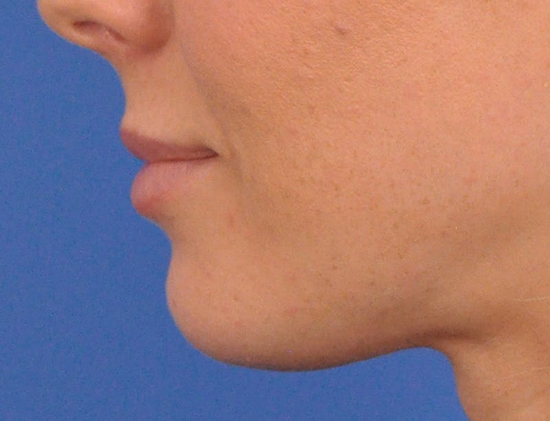 Lip Filler Before & After Gallery - Patient 144651 - Image 10