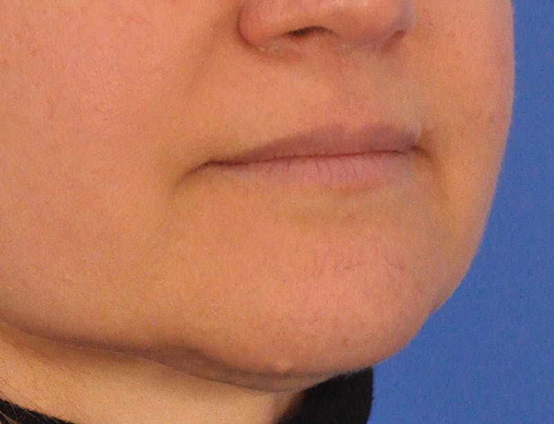 Lip Filler Before & After Gallery - Patient 844472 - Image 3